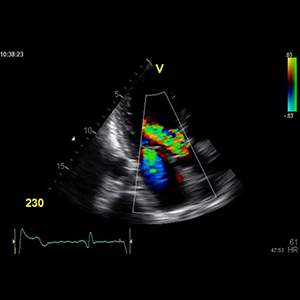 Doppler study
