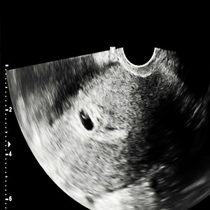 Early pregnancy ultrasound