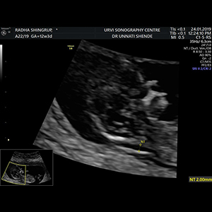 Trimester Screening